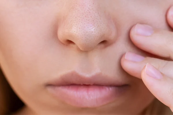 Zbliżenie na twarz kobiety, na jej nosie widnieje duża ilość zatkanych porów